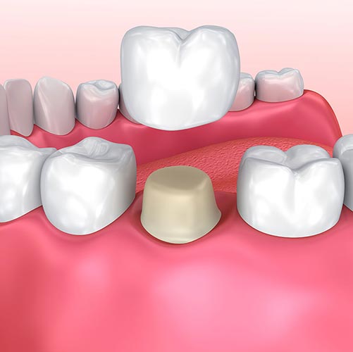 Procedure to place a dental crown in Mississauga