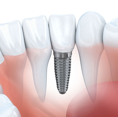 dental implant restorative dentistry illustration in Mississauga