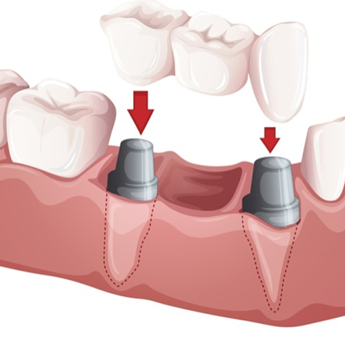 illustrative image of dental bridges in Mississauga