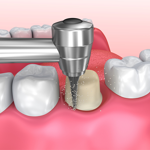 illustrative image of dental crowns in Mississauga