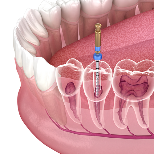 illustrative image of root canals in Mississauga